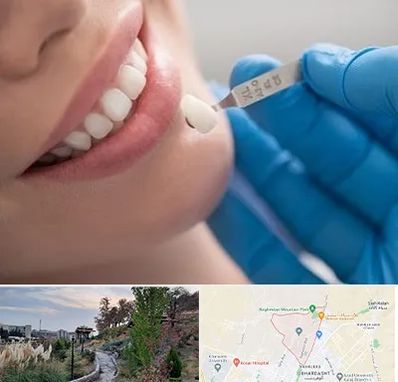 مرکز لمینت دندان در باغستان کرج