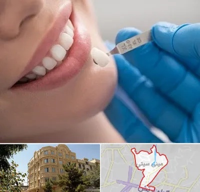مرکز لمینت دندان در مینی سیتی