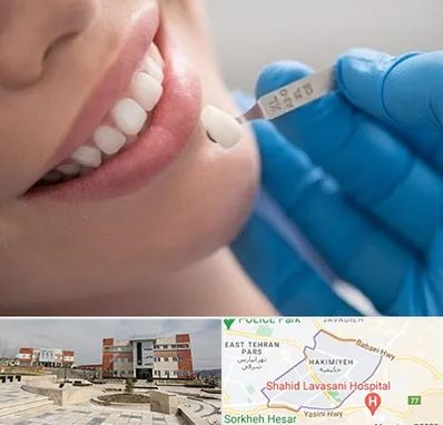 مرکز لمینت دندان در حکیمیه