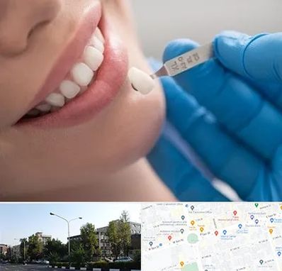 مرکز لمینت دندان در میدان کاج