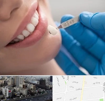 مرکز لمینت دندان در زرتشت