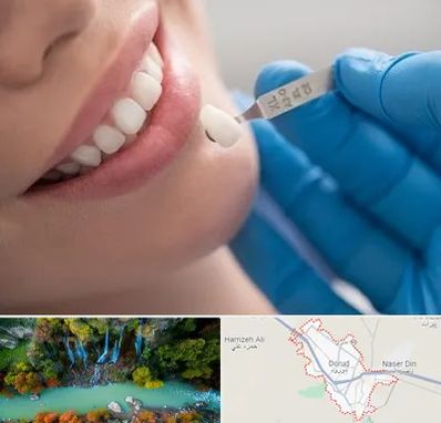 مرکز لمینت دندان در دورود