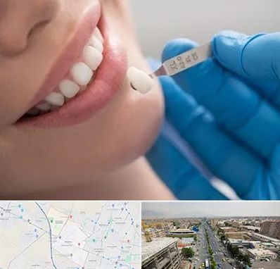 مرکز لمینت دندان در حصارک کرج