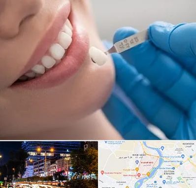 مرکز لمینت دندان در کیانپارس اهواز