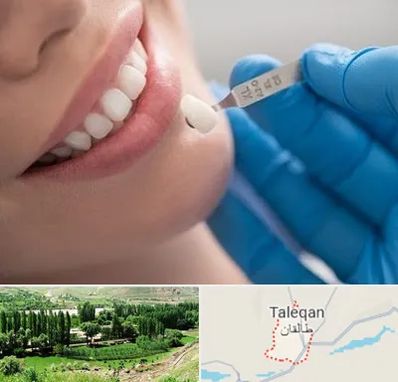 مرکز لمینت دندان در طالقان