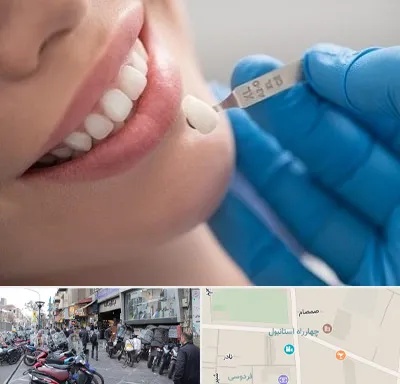مرکز لمینت دندان در چهارراه استانبول