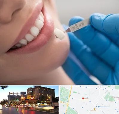 مرکز لمینت دندان در بلوار سجاد مشهد