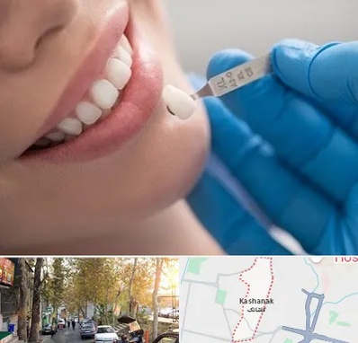 مرکز لمینت دندان در کاشانک