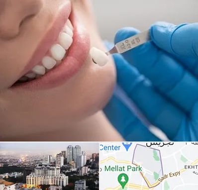 مرکز لمینت دندان در الهیه