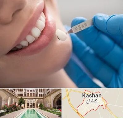 مرکز لمینت دندان در کاشان