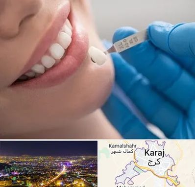 مرکز لمینت دندان در کرج