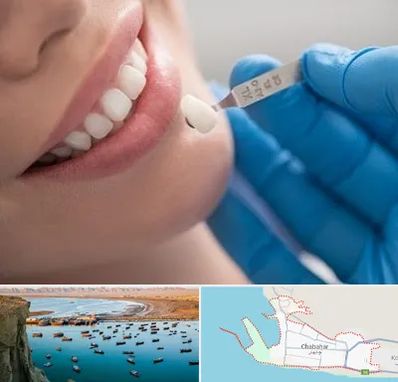 مرکز لمینت دندان در چابهار