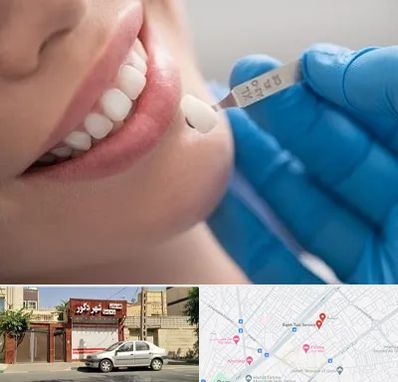 مرکز لمینت دندان در باجک قم