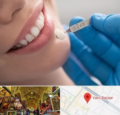 مرکز لمینت دندان در بازار وکیل شیراز