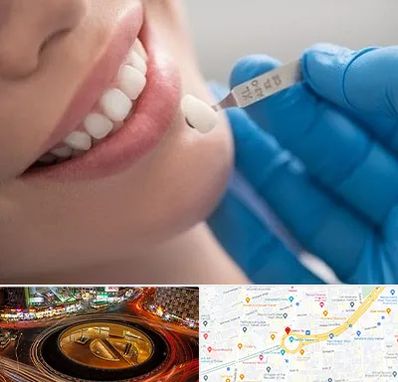 مرکز لمینت دندان در میدان ولیعصر