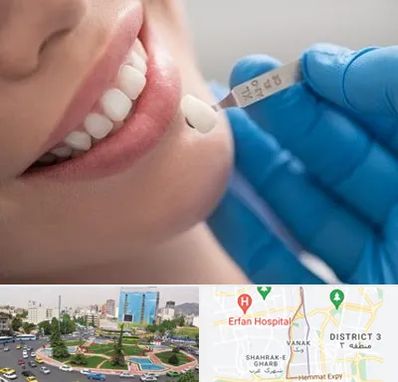 مرکز لمینت دندان در ونک تهران