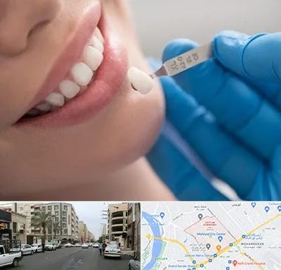 مرکز لمینت دندان در زیتون کارمندی اهواز