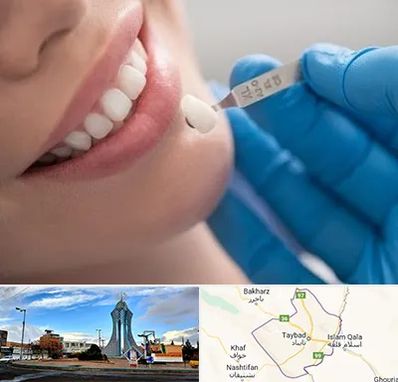 مرکز لمینت دندان در تایباد