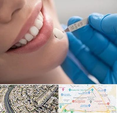 مرکز لمینت دندان در شهرک غرب مشهد