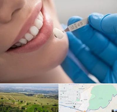 مرکز لمینت دندان در سوهانک