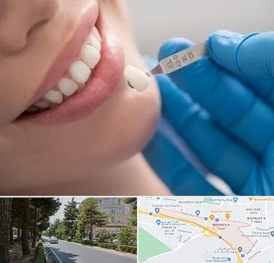 مرکز لمینت دندان در مهرویلا کرج