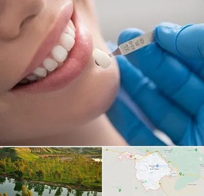 مرکز لمینت دندان در بهبهان