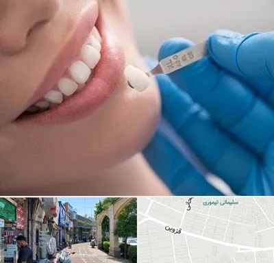 مرکز لمینت دندان در خیابان قزوین