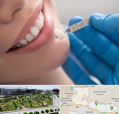 مرکز لمینت دندان در پردیس