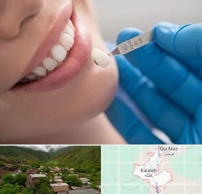 مرکز لمینت دندان در کلاله