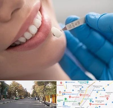 مرکز لمینت دندان در شریعتی