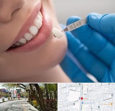 مرکز لمینت دندان در خیابان توحید اصفهان