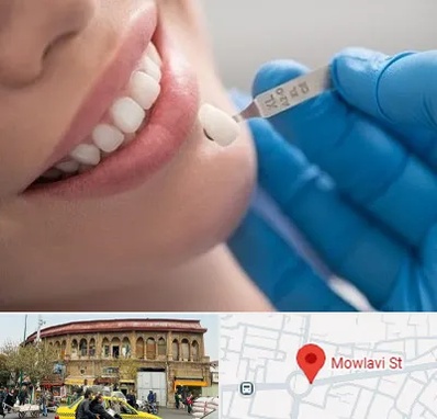 مرکز لمینت دندان در مولوی