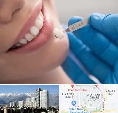 مرکز لمینت دندان در شهرک غرب تهران