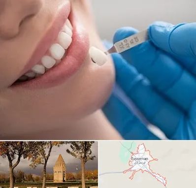 مرکز لمینت دندان در تویسرکان