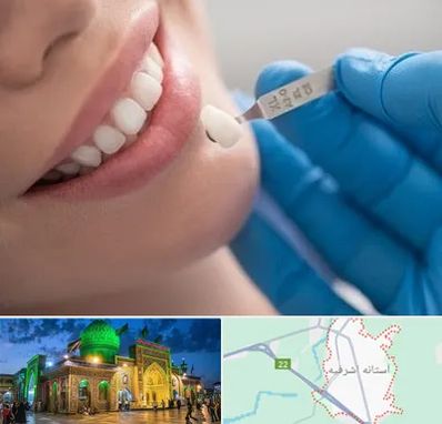 مرکز لمینت دندان در آستانه اشرفیه