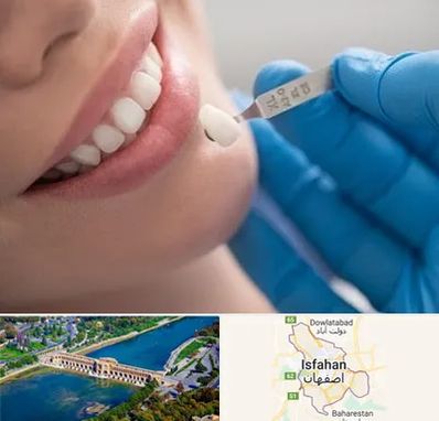 مرکز لمینت دندان در اصفهان