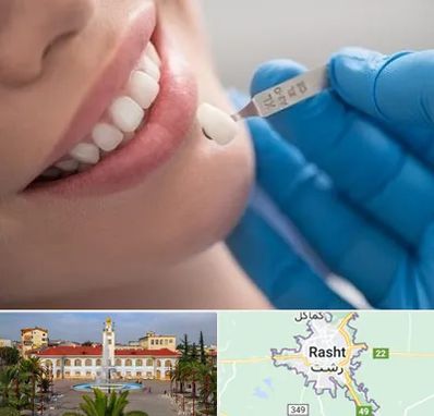 مرکز لمینت دندان در رشت