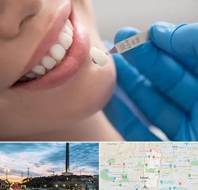 مرکز لمینت دندان در منطقه 2 تهران