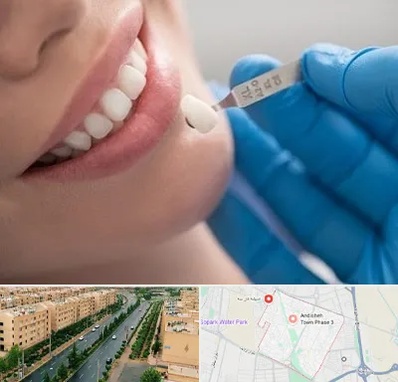 مرکز لمینت دندان در فاز سه اندیشه