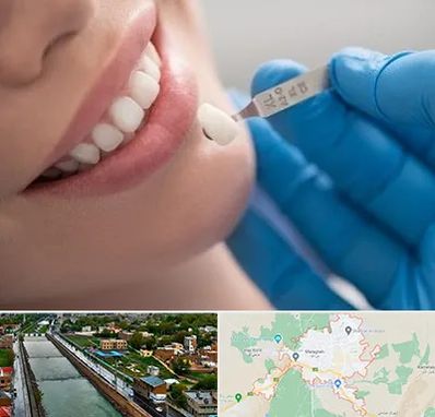 مرکز لمینت دندان در مراغه