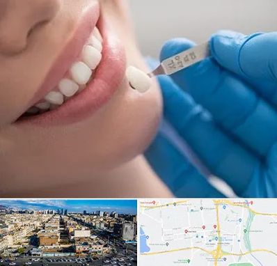 مرکز لمینت دندان در شهرک راه آهن