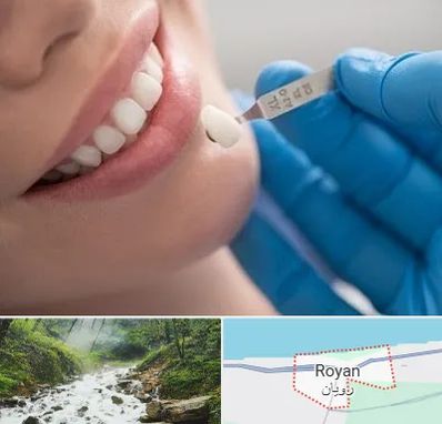 مرکز لمینت دندان در رویان