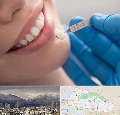 مرکز لمینت دندان در منطقه 4 تهران