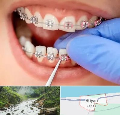 مرکز ارتودنسی دندان در رویان