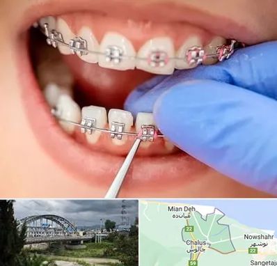 مرکز ارتودنسی دندان در چالوس