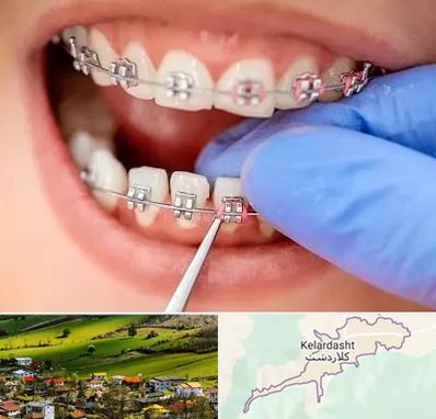 مرکز ارتودنسی دندان در کلاردشت