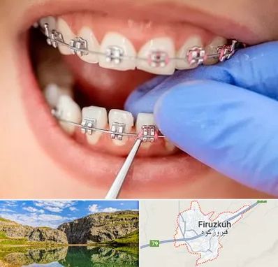 مرکز ارتودنسی دندان در فیروزکوه