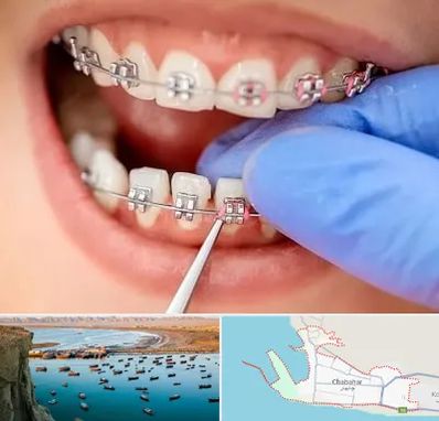 مرکز ارتودنسی دندان در چابهار