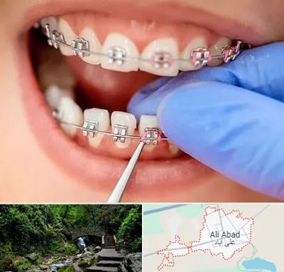 مرکز ارتودنسی دندان در علی آباد کتول