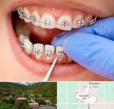 مرکز ارتودنسی دندان در کلاله